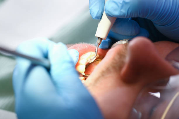 Best Emergency Dentist for Lost Fillings or Crowns in East Setauket, NY